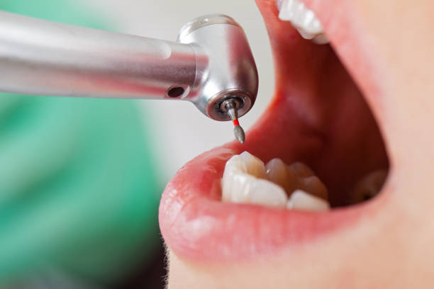 Best Emergency Root Canal Therapy in Larkspur, CA